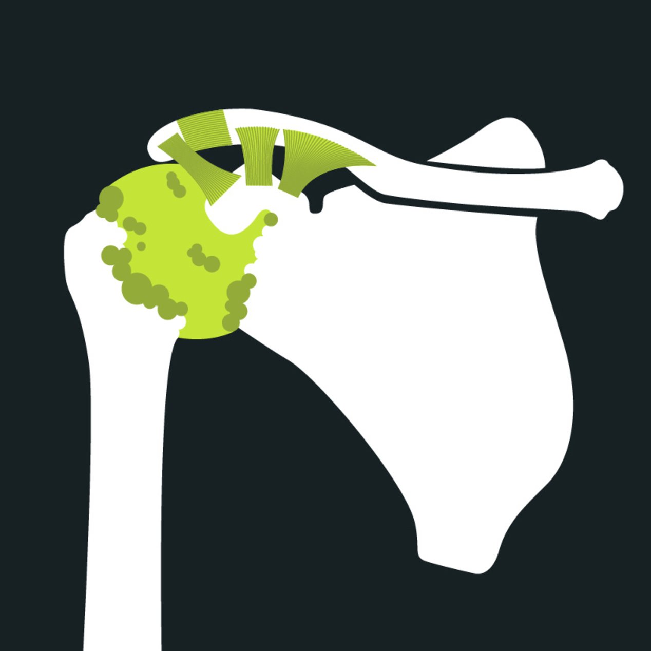 Anatomy of Shoulder Osteoarthritis