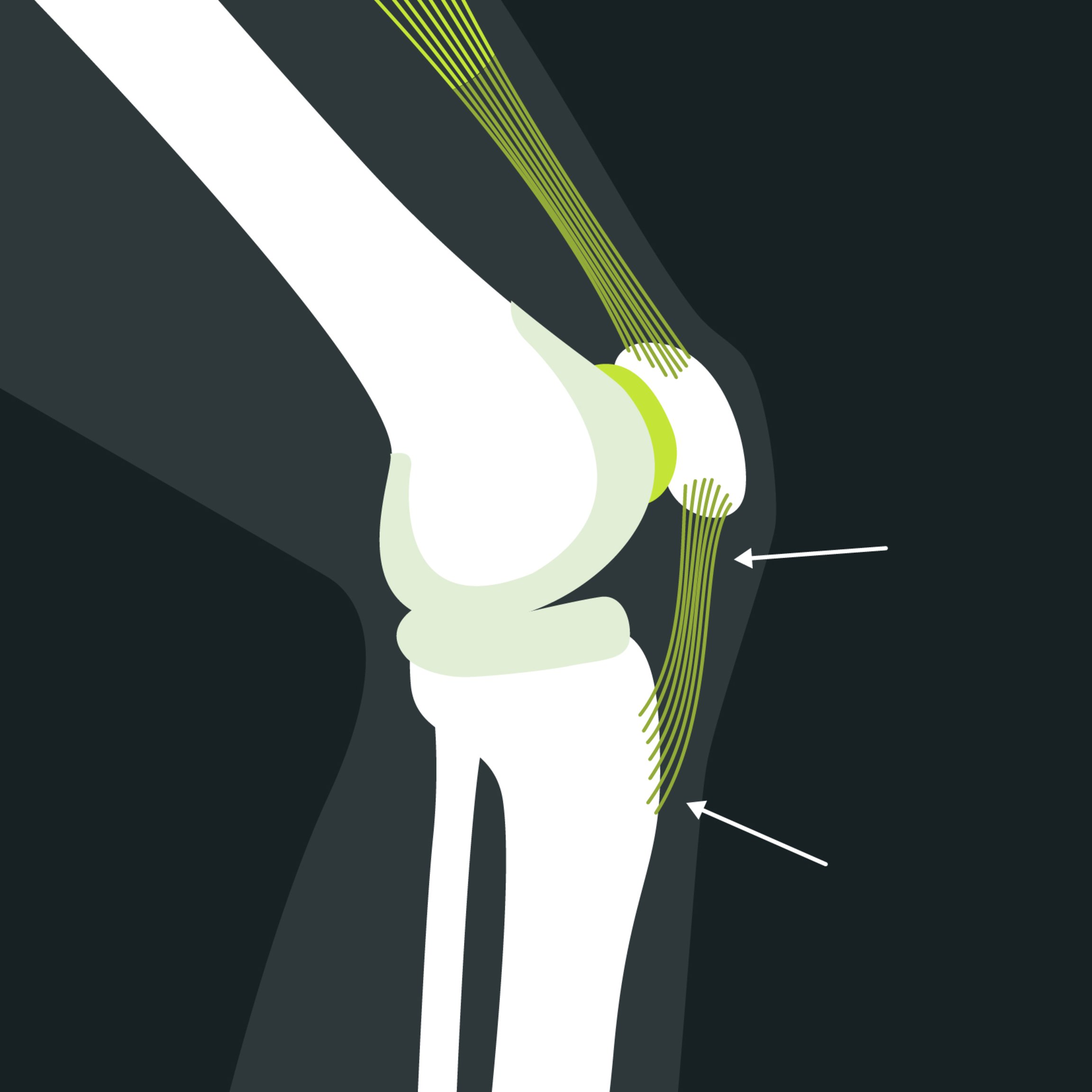 Anatomie du syndrome de la pointe de la rotule : douleurs au genou