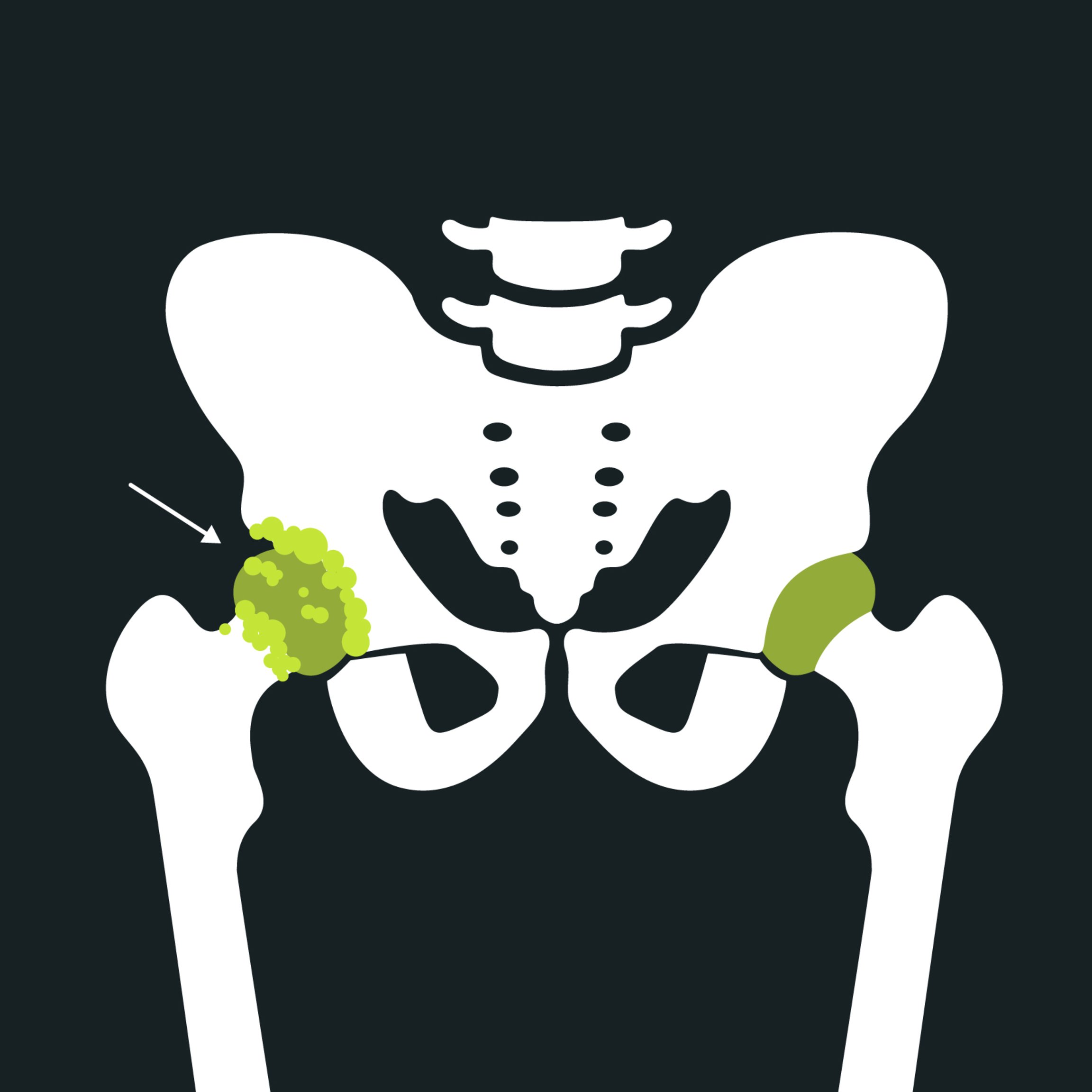 Anatomy of Hip Pain: Hip Osteoarthritis