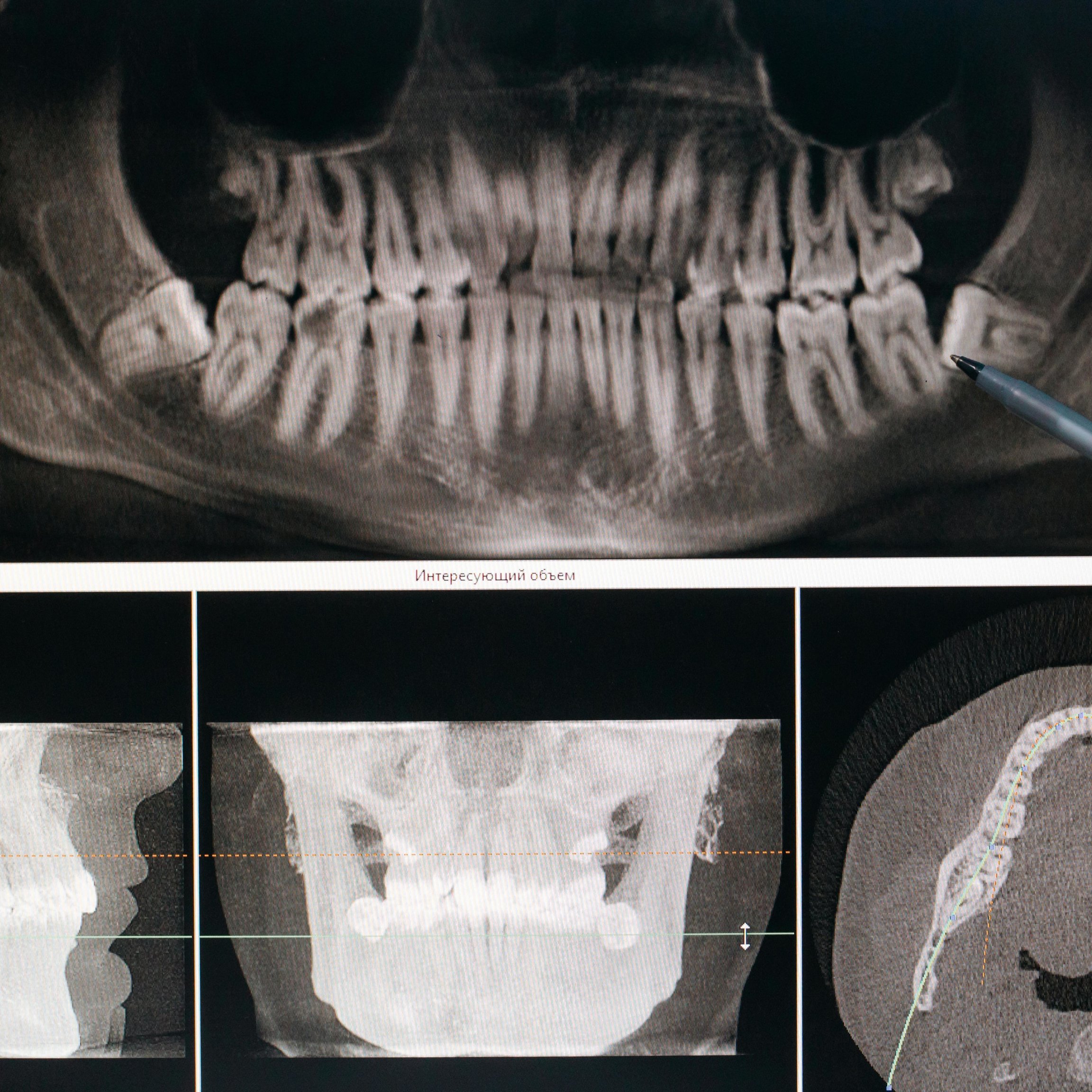 Teeth Grinding (Bruxism)
