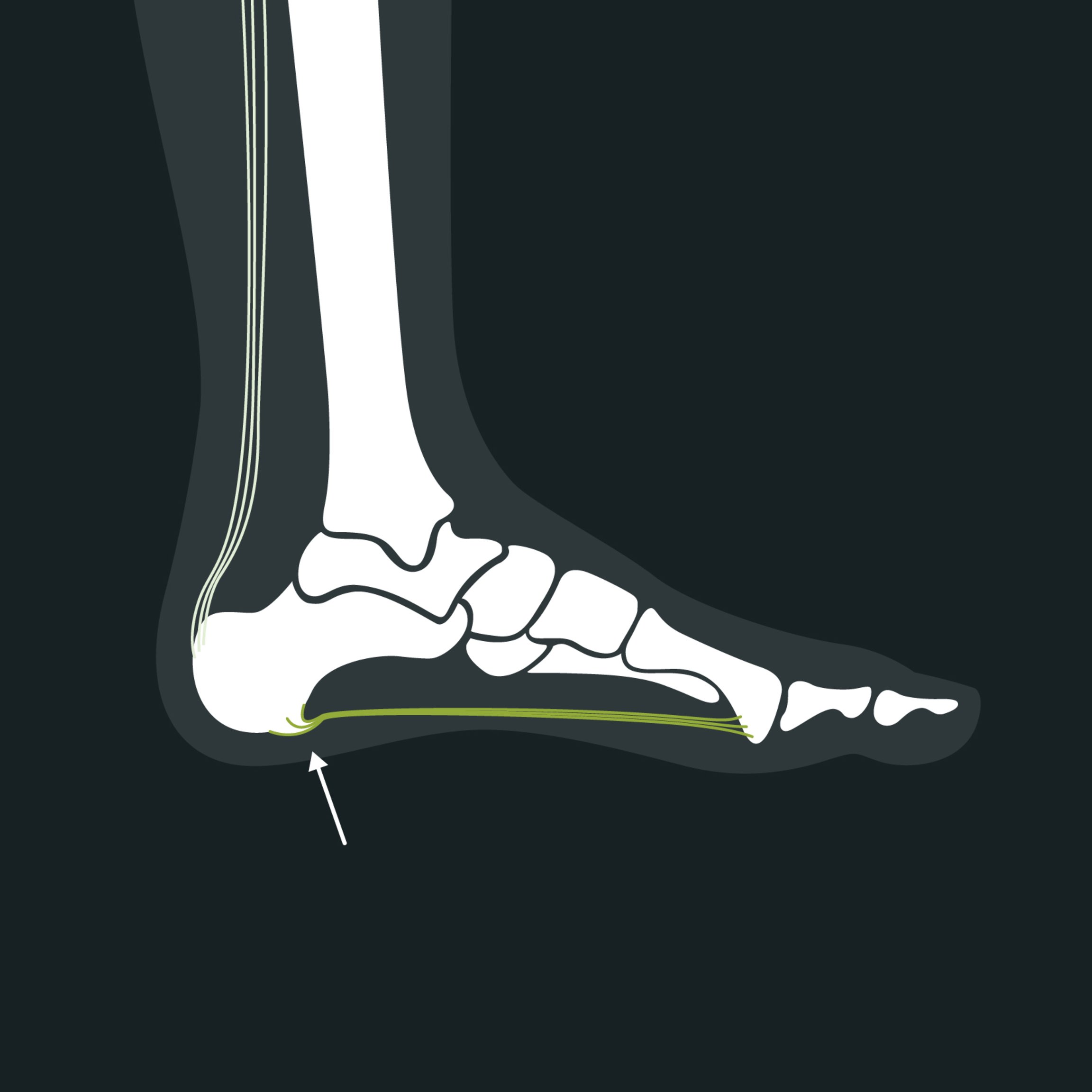 Anatomy of a lower heel spur