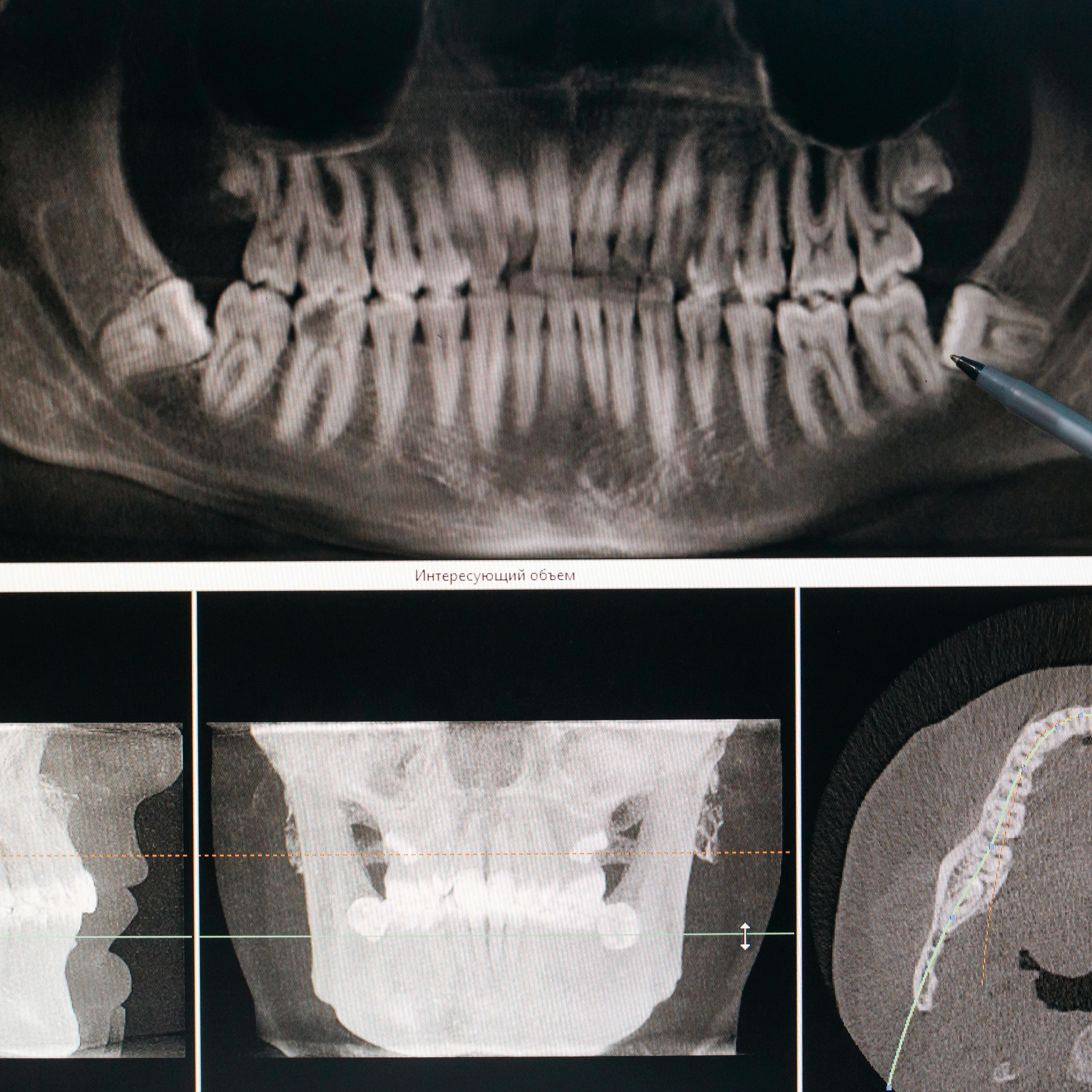 Teeth Grinding (Bruxism)