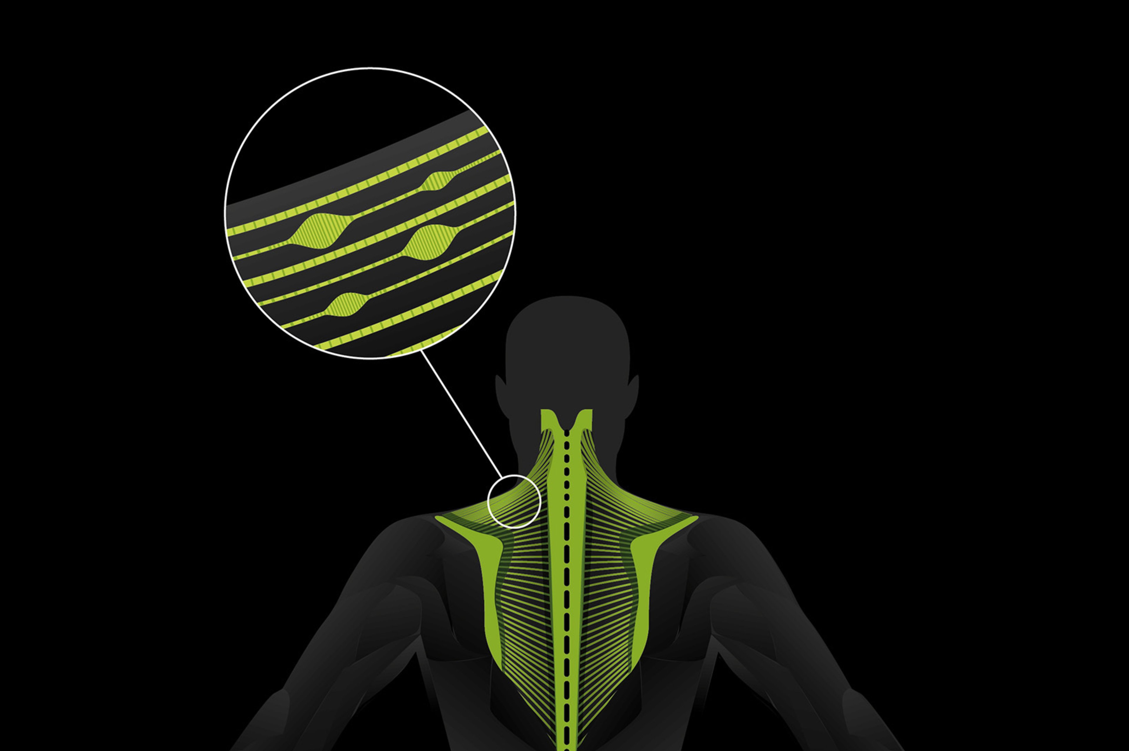 Points gâchettes dans le tissu fascial