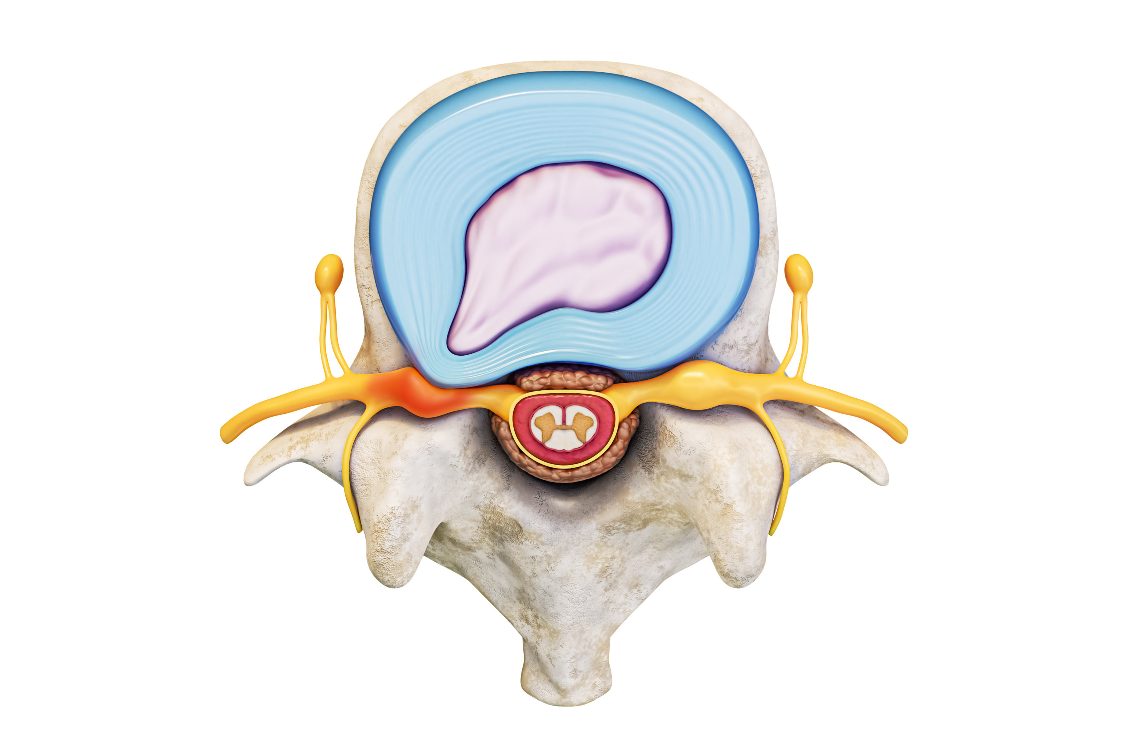 Herniated disc in the upper back: the symptoms