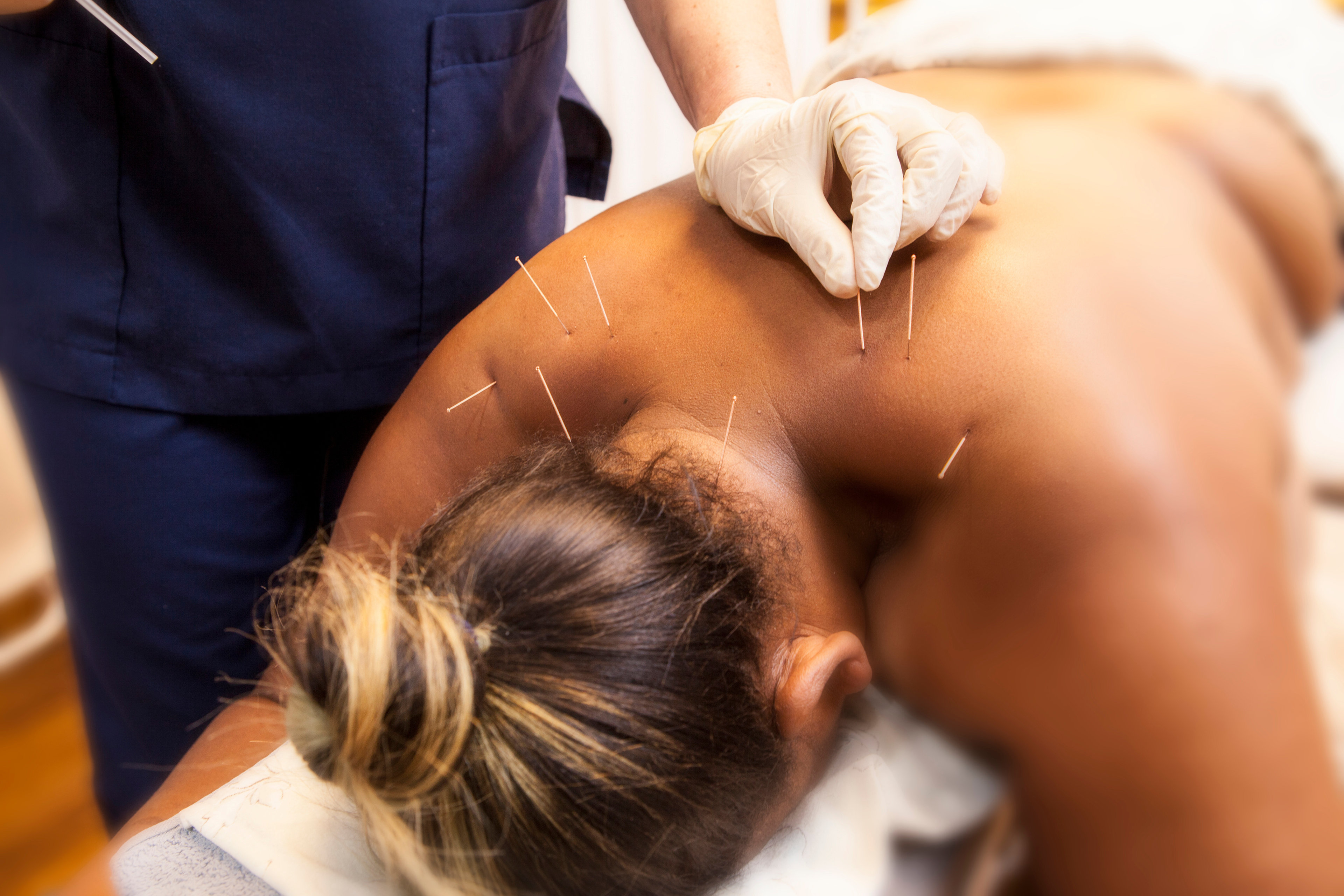 Technique d’acupuncture « Dry Needling » des points gâchettes