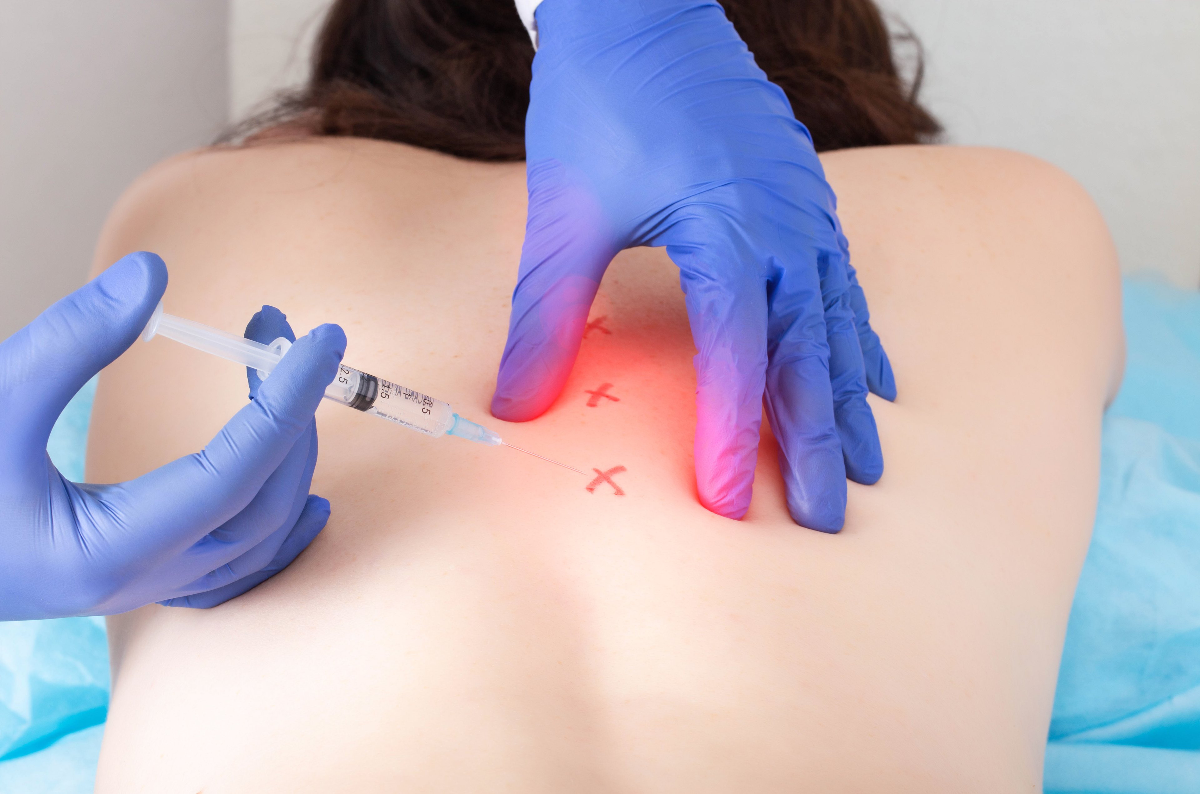 Injections dans les points gâchettes
