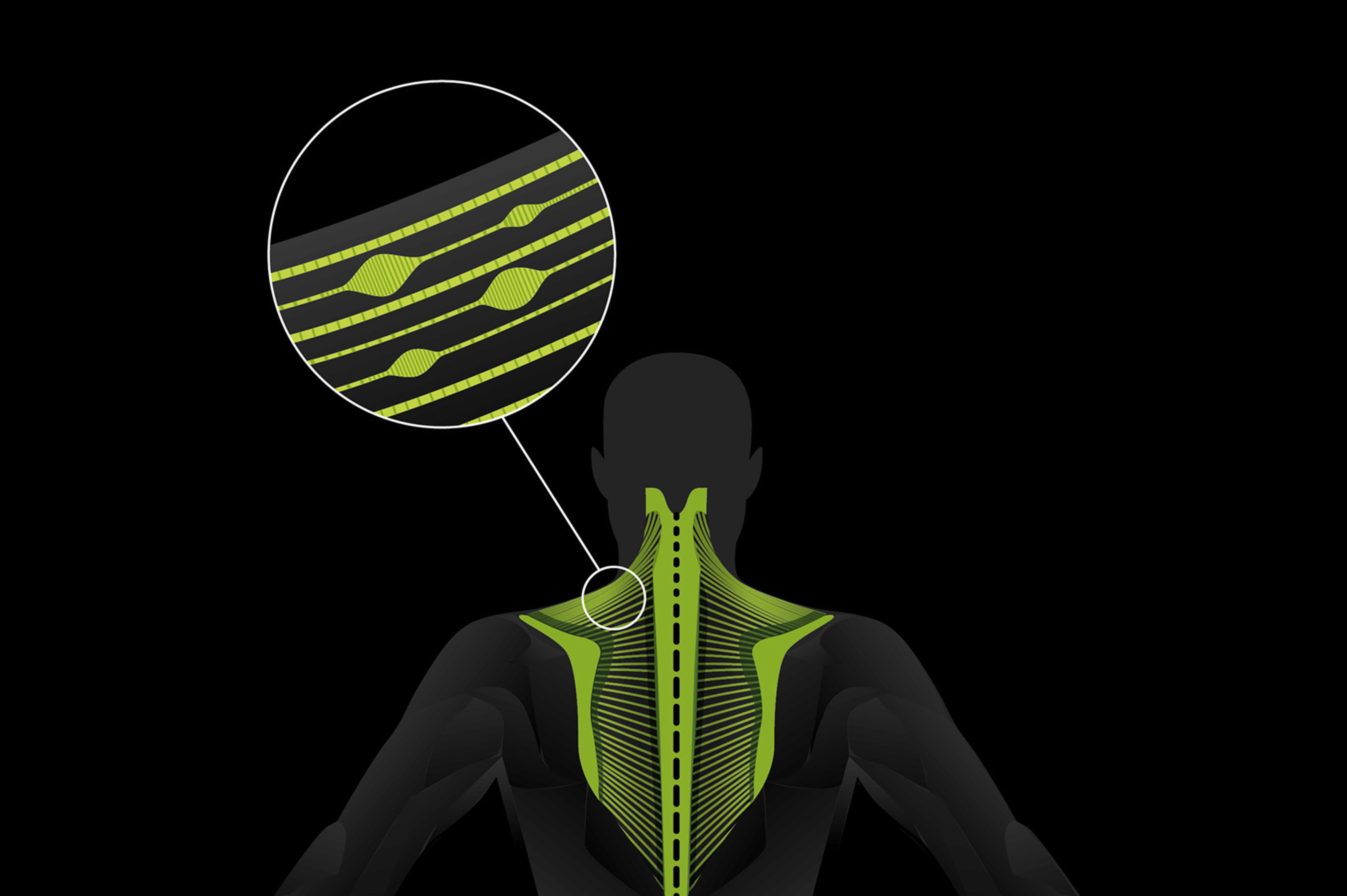Trigger Points in Fascial Tissue