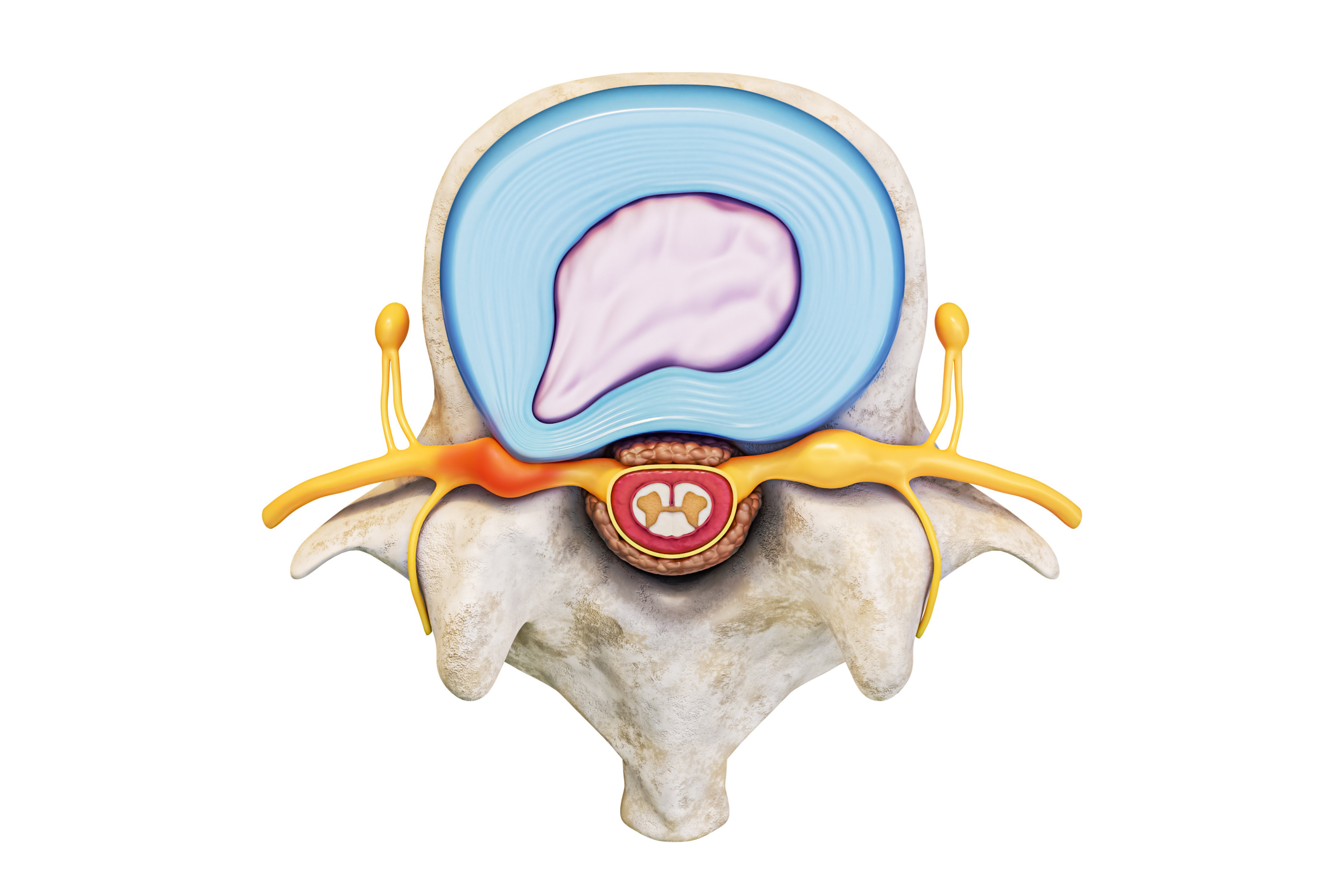 Herniated disc in the upper back: the symptoms