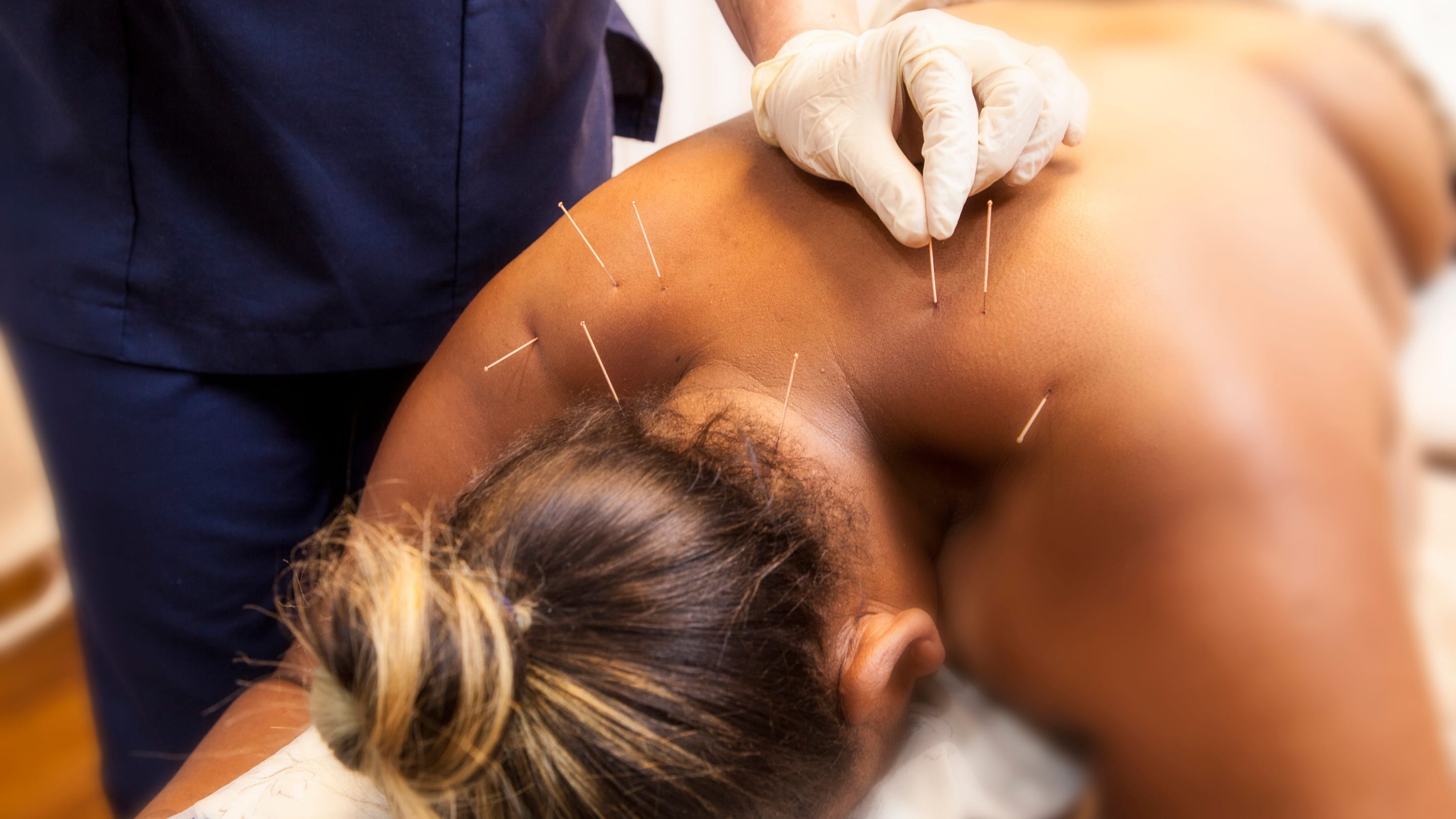 Triggerpunkte dry needeling akupunktur