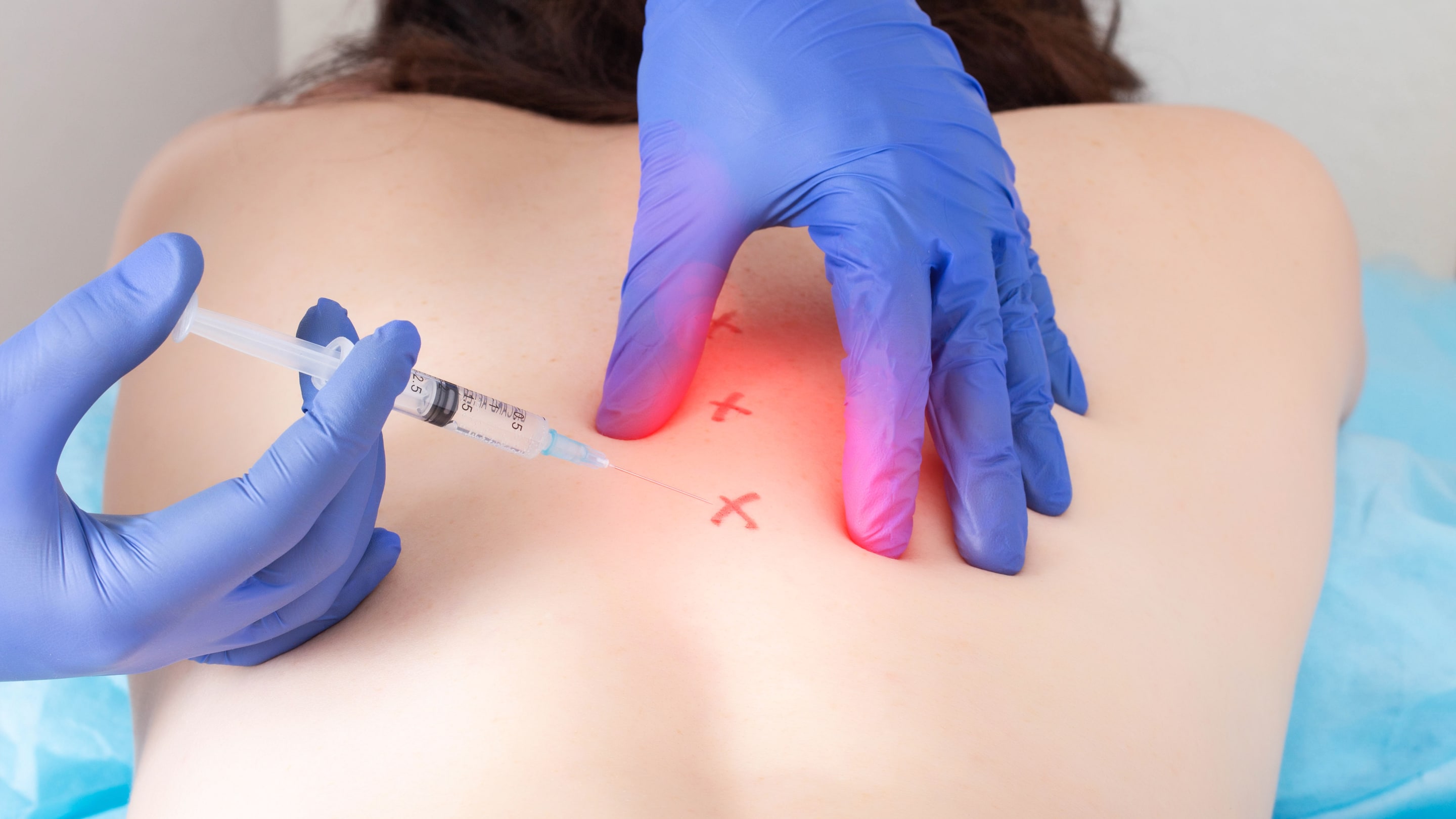 Triggerpunkte injektionen