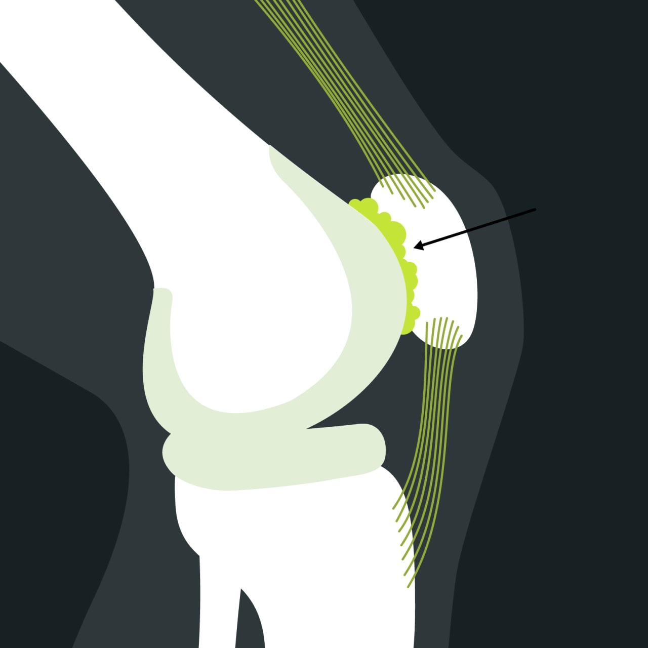 Anatomie patellofemorales schmerzsyndrom blackroll