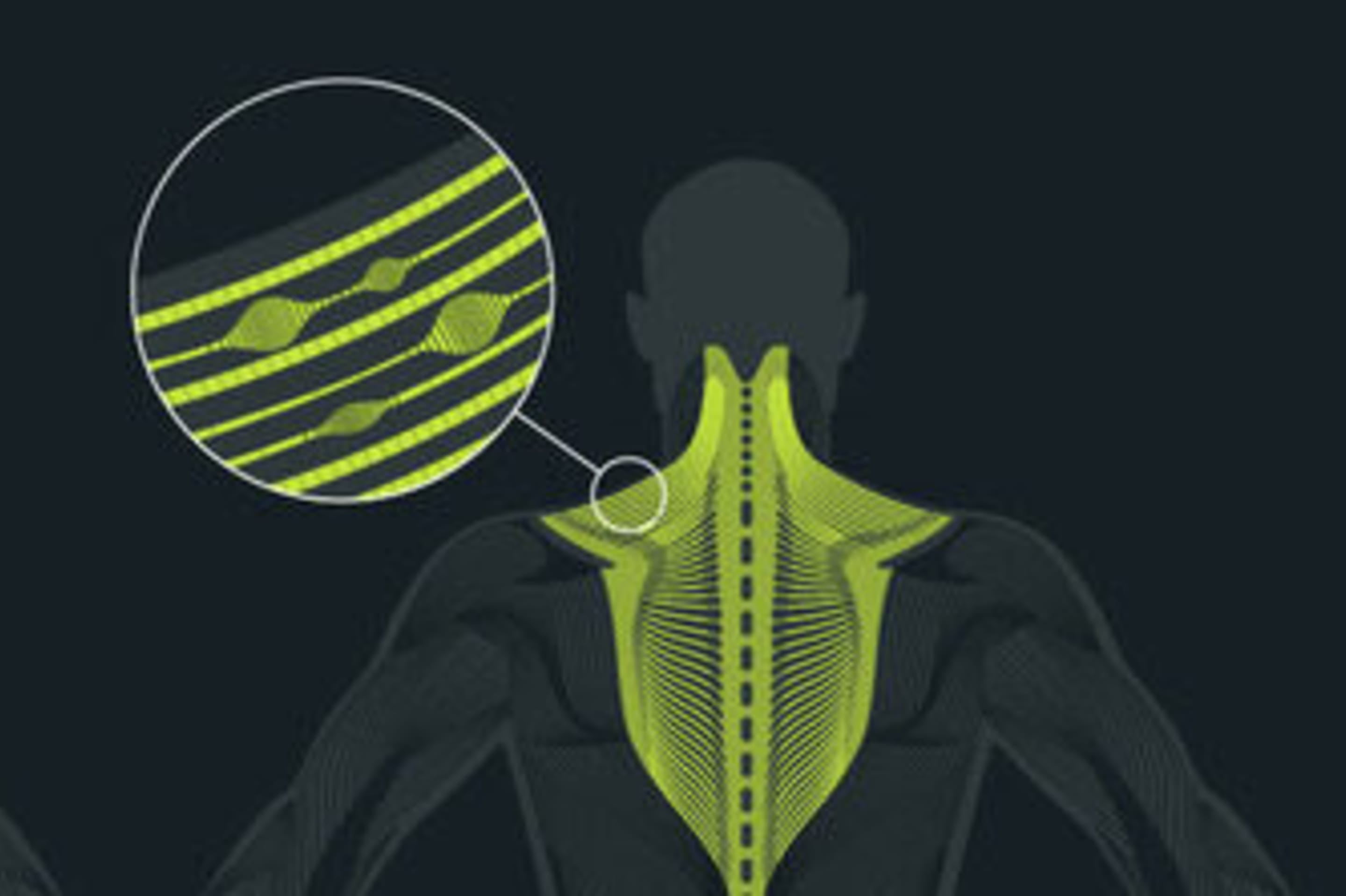 Triggerpunkte im Fasziengewebe
