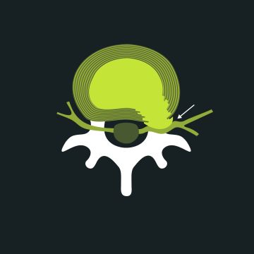 Anatomie bandscheibenvorfall blackroll