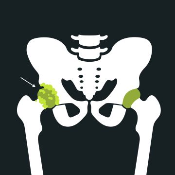 Hueftarthrose huefschmerzen blackroll