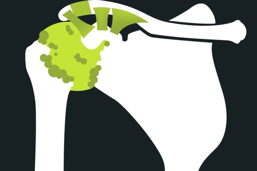 Anatomie einer Schulterarthrose