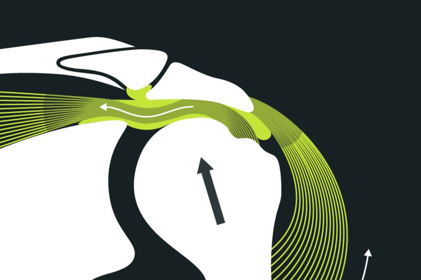 Anatomie eines Schulter impingements